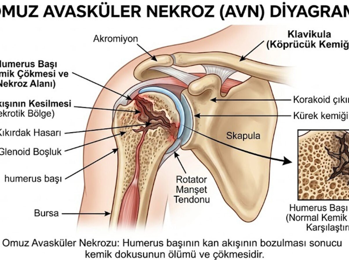 omuz-avaskuler-nekroz